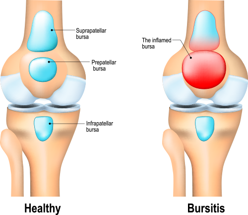 bursitis treatment colts neck nj